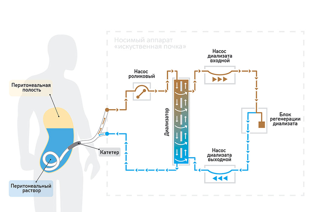 Принцип работы аппарата искусственная почка рисунок
