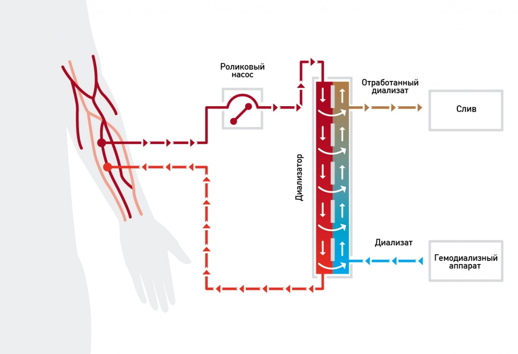 Принцип работы аппарата искусственная почка рисунок